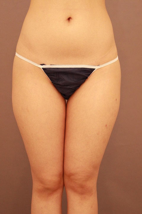 太もも　脂肪吸引　２か月経過