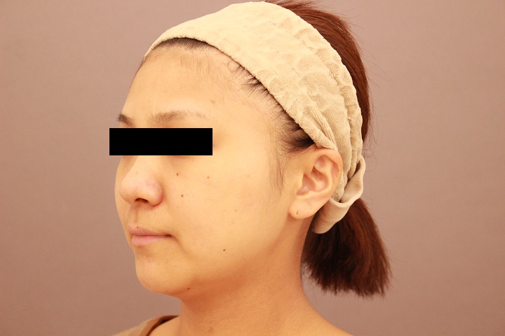 顔の脂肪吸引　３か月経過