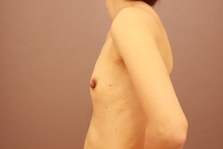 コンデンスリッチ豊胸　３か月経過