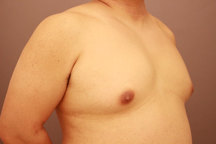 女性化乳房　半年経過