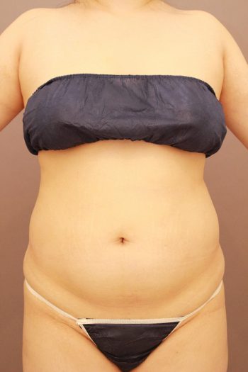 腹部全体 脂肪吸引 半年経過