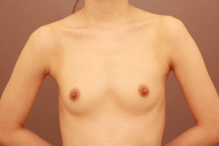 コンデンスリッチ豊胸 1週間経過