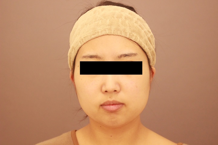 顔の脂肪吸引　３か月経過