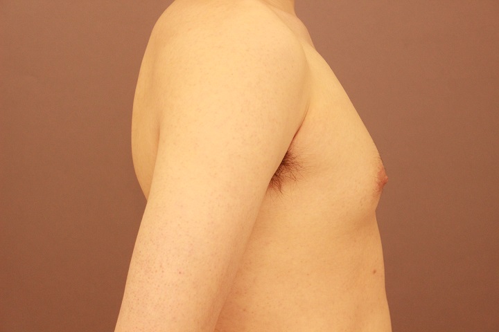 女性化乳房 1か月経過
