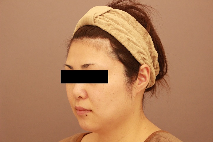 顔の脂肪吸引 1か月経過