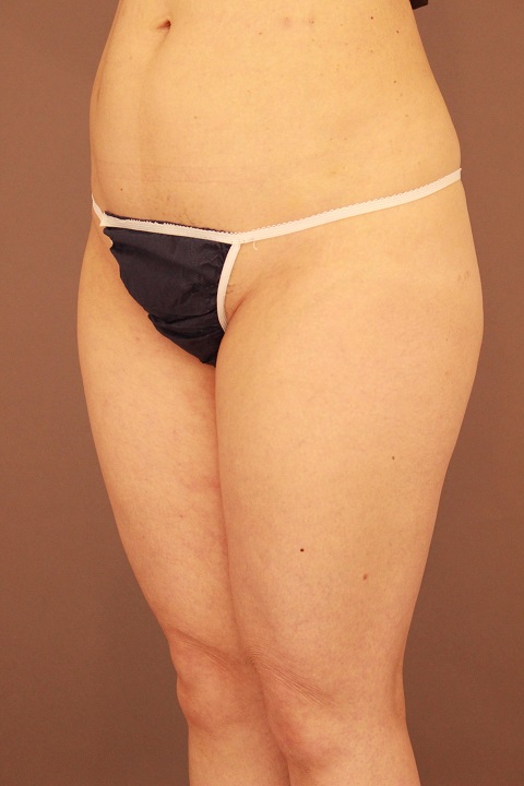 太もも　脂肪吸引　１か月経過