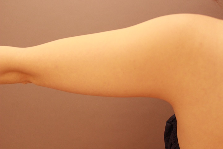 二の腕・肩 脂肪吸引 3か月経過