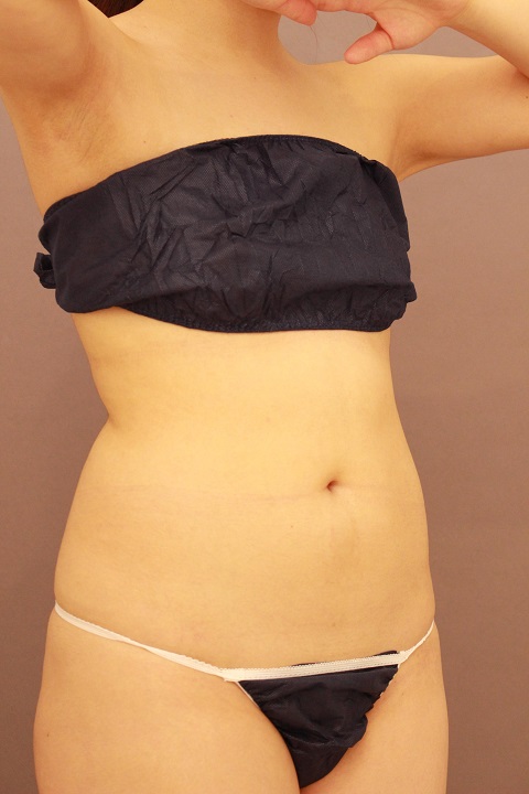 腹部全体 脂肪吸引 半年後