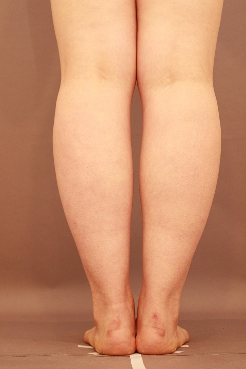 ふくらはぎ　脂肪吸引　３か月経過