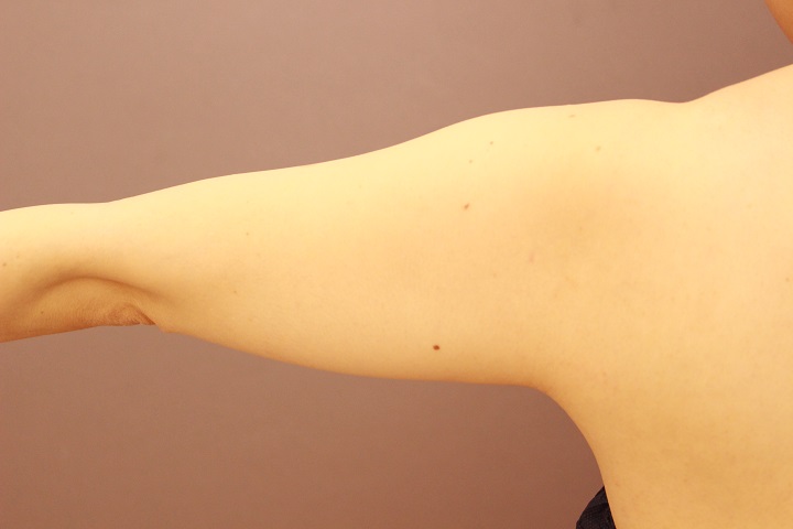二の腕・肩　脂肪吸引　半年経過