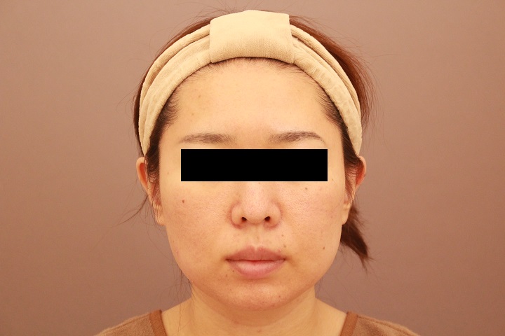 顔の脂肪吸引　１か月経過