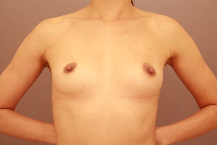 コンデンスリッチ豊胸　１か月経過