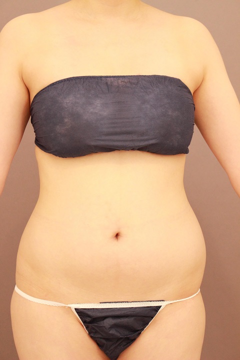 お腹全体 脂肪吸引 3か月後