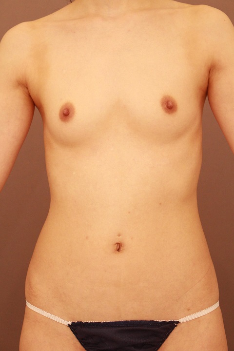 痩せている方のコンデンスリッチ豊胸　１か月経過