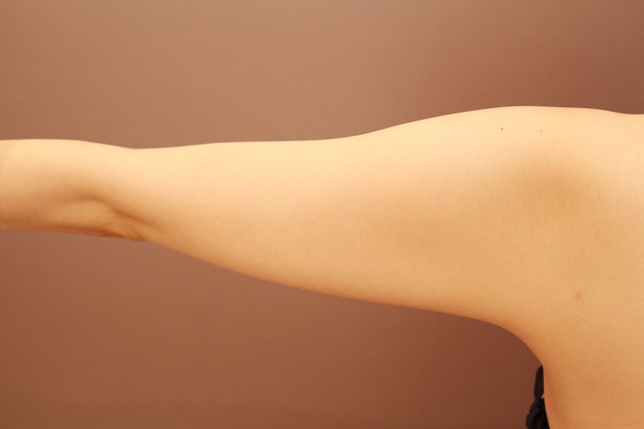 二の腕・肩　脂肪吸引　１か月経過