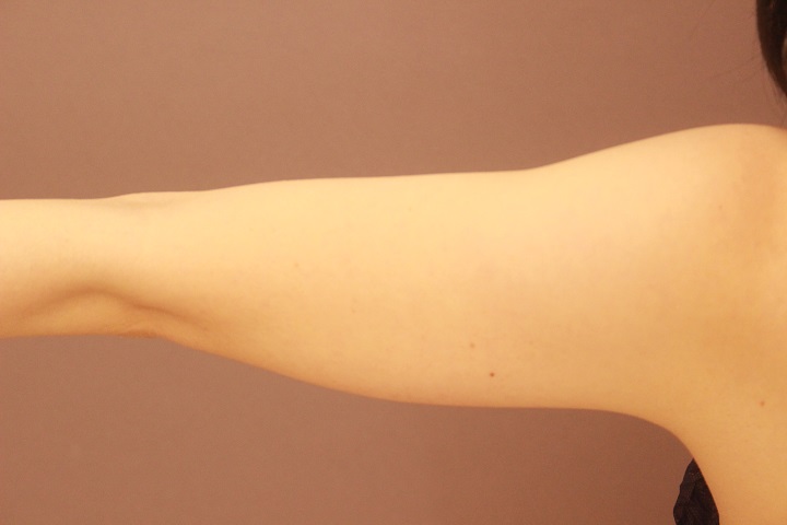 二の腕・肩　脂肪吸引　３か月経過