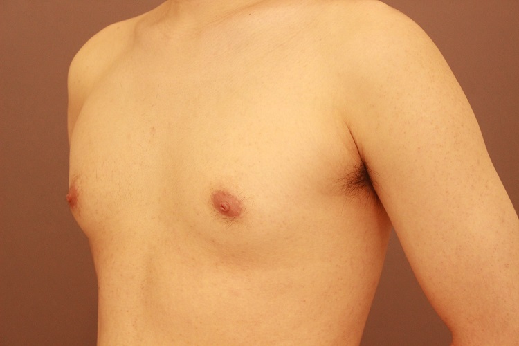 女性化乳房　３か月経過