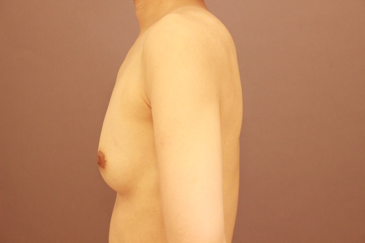 コンデンスリッチ豊胸　３か月経過