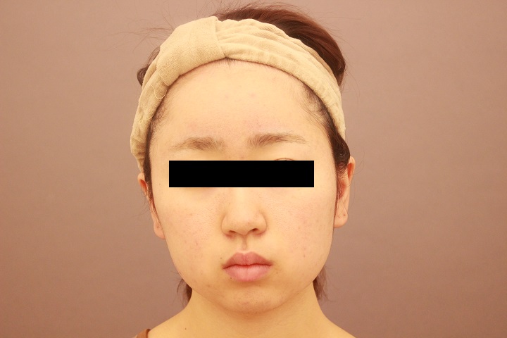 顔の脂肪吸引　３か月経過