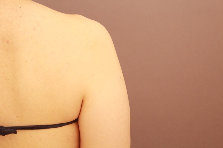 二の腕・肩　１か月経過