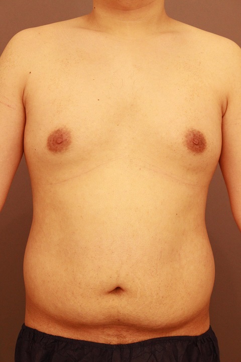男性の上半身と女性化乳房 3か月後経過