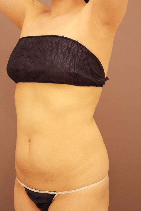 腹部全体 脂肪吸引 1か月経過