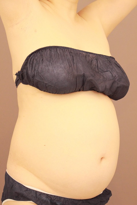 お腹回りの脂肪吸引 3か月経過