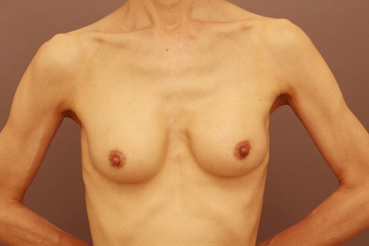 シリコンバック抜去＆コンデンスリッチ豊胸　１か月経過