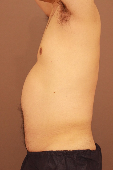 男性の上半身の脂肪吸引　１か月経過