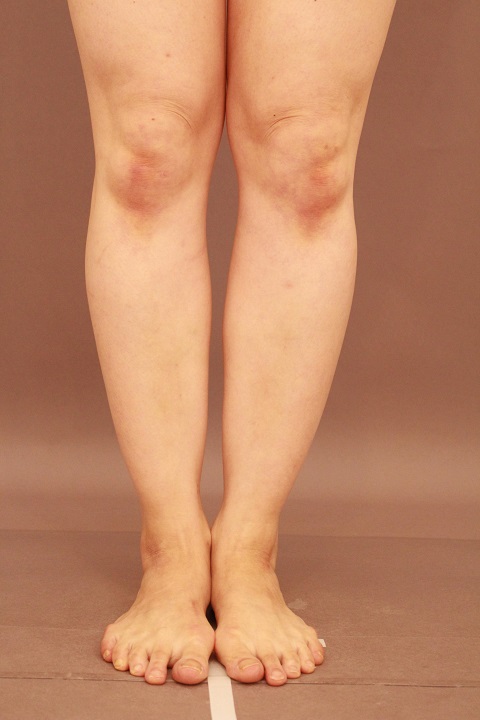 ふくらはぎ　脂肪吸引　１か月経過