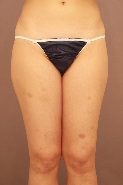 太もも 脂肪吸引 半年後