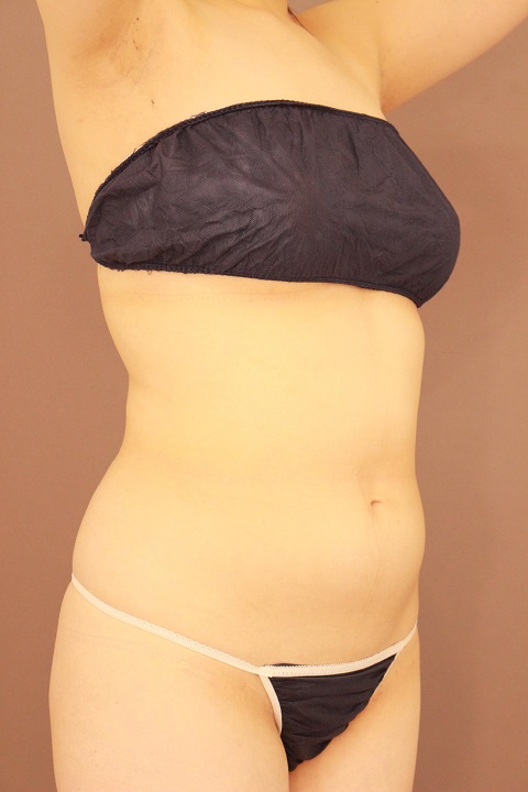 お腹回りの脂肪吸引 1か月経過