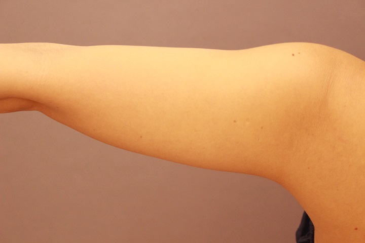 二の腕　脂肪吸引　２か月経過