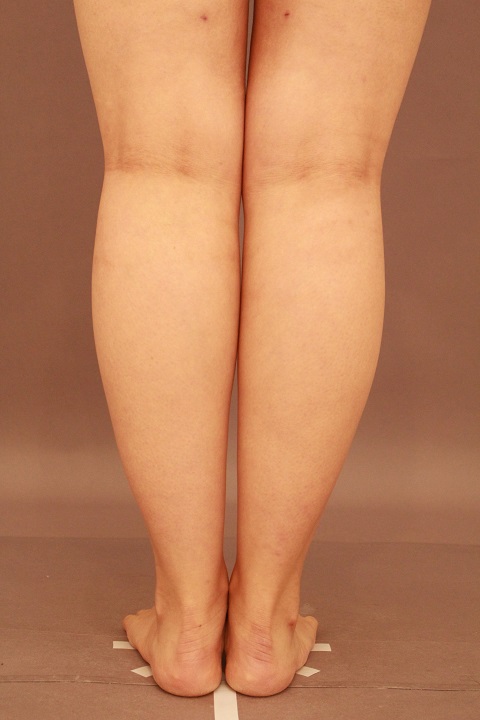 ふくらはぎ　脂肪吸引　３か月経過　