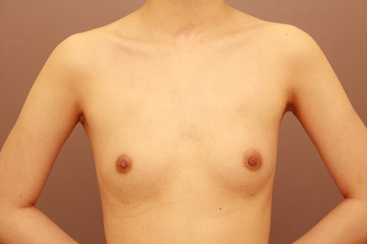 コンデンスリッチ豊胸 1か月経過