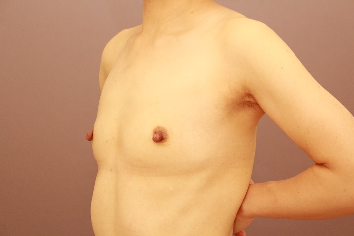 コンデンスリッチ豊胸+乳首縮小 1か月経過