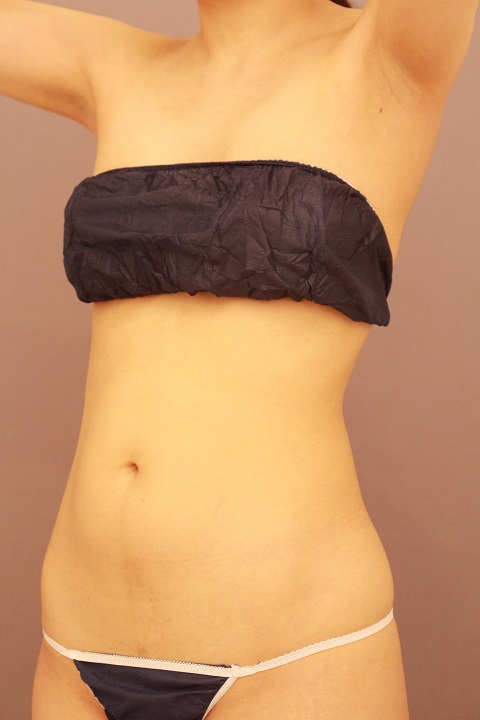 お腹のの脂肪吸引 3か月経過