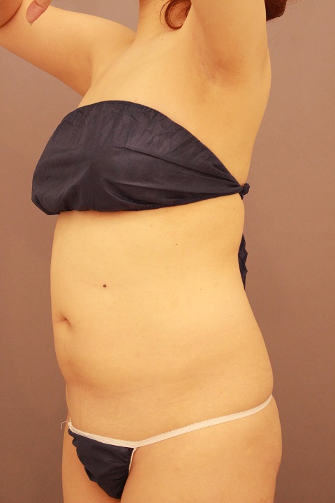 お腹回りの脂肪吸引 半年経過