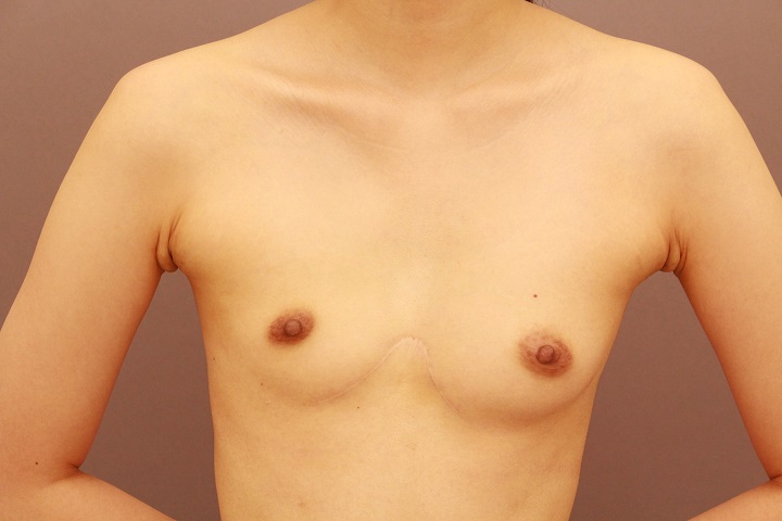 漏斗胸の治療としてのコンデンスリッチ豊胸