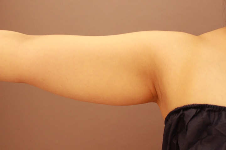 二の腕　脂肪吸引　半年経過