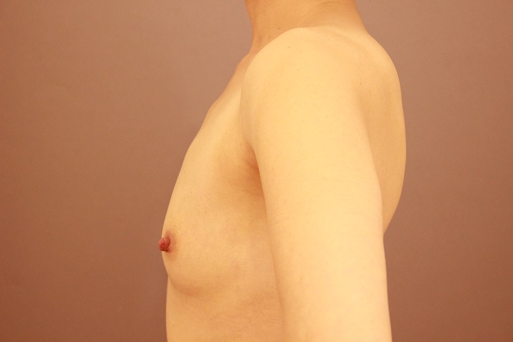 コンデンスリッチ豊胸 1か月経過