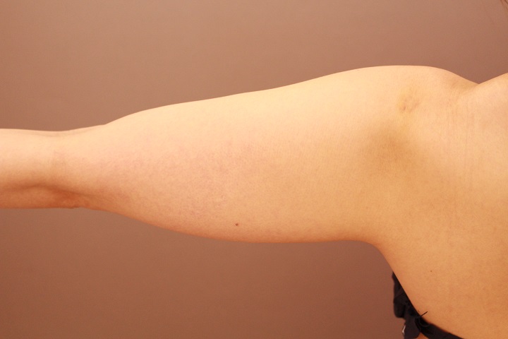 二の腕 脂肪吸引 3か月経過