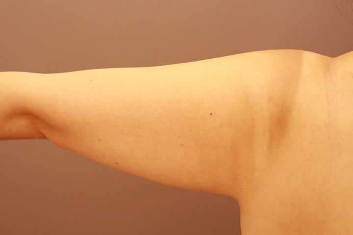 二の腕・肩　脂肪吸引　１か月経過