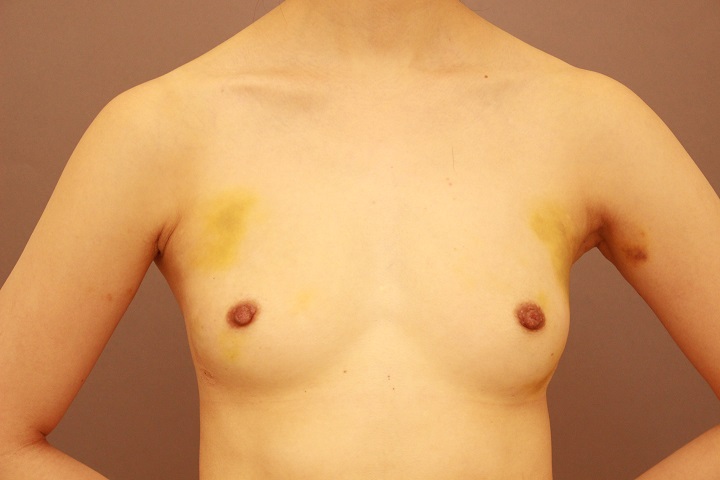 アクアフィリング除去からのコンデンスリッチ豊胸