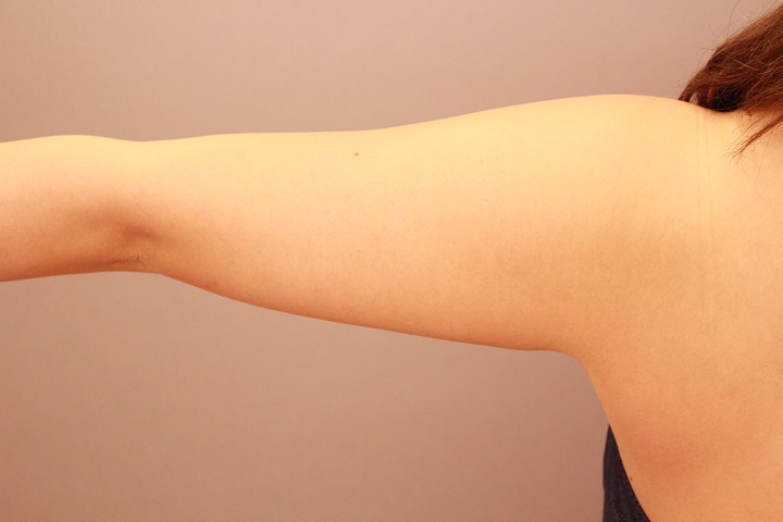二の腕・肩 3か月経過