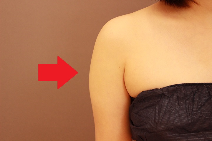 二の腕・肩　脂肪吸引　１か月経過