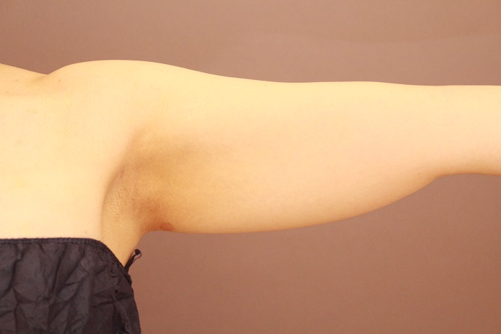 二の腕・肩　ベイザー脂肪吸引　半年経過