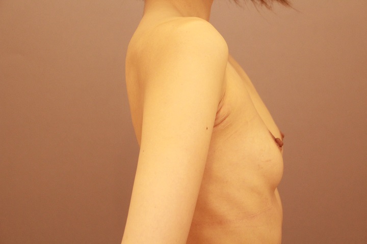 コンデンスリッチ豊胸　１か月経過