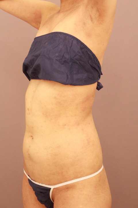 お腹の脂肪吸引 1か月経過