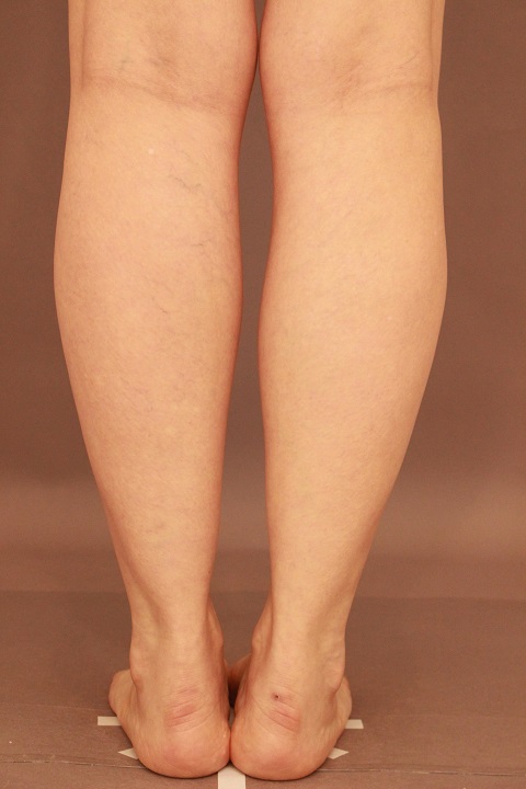 ふくらはぎ　脂肪吸引　半年経過